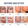 Hifu 7D Superiority 5 in 1 apparatuur - Afbeelding 12