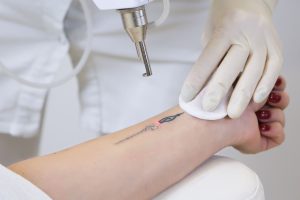 Tattoo removal picolaser