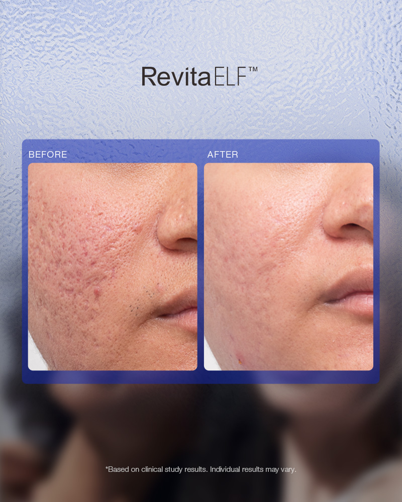 RevitaELF Laser | Innovatieve lasertherapie tegen haarverlies - Afbeelding 9