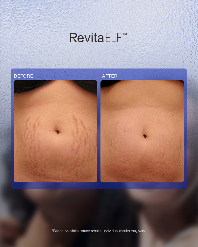 RevitaELF Laser | Innovatieve lasertherapie tegen haarverlies - Afbeelding 8