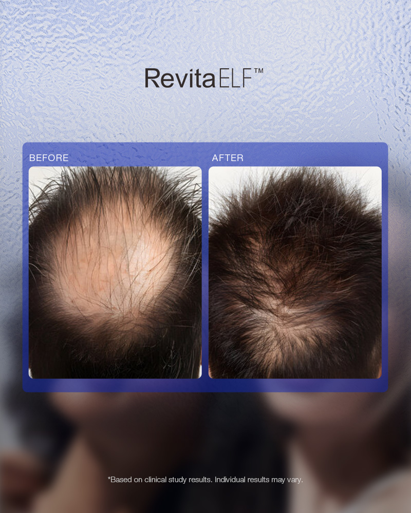 RevitaELF Laser | Innovatieve lasertherapie tegen haarverlies - Afbeelding 6